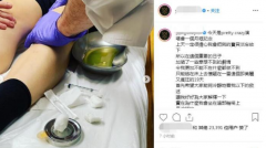 容祖儿坐轮椅就医，从膝盖抽出50cc液体，害怕截肢！