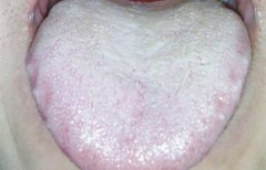 舌苔厚白是怎么回事 舌苔