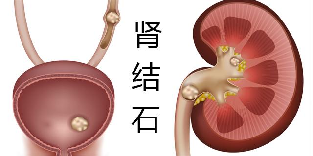 预防肾结石，就得这样饮食！