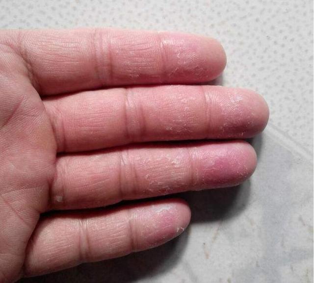 秋季手脚脱皮太烦人,教你一个小妙招,轻松帮你解烦恼