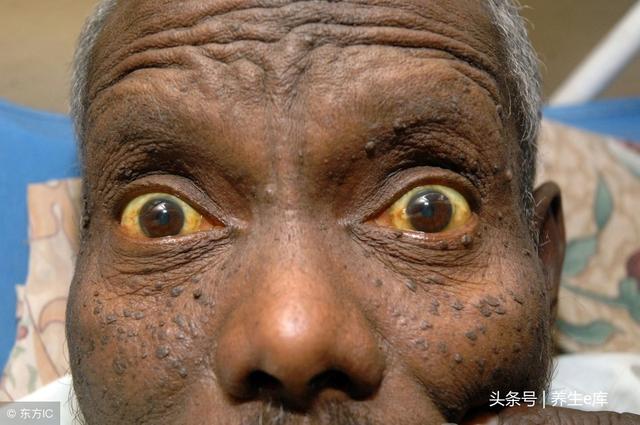 肝不好,身体1处变白、2处变黄、3处变黑,提醒你该去检查一下