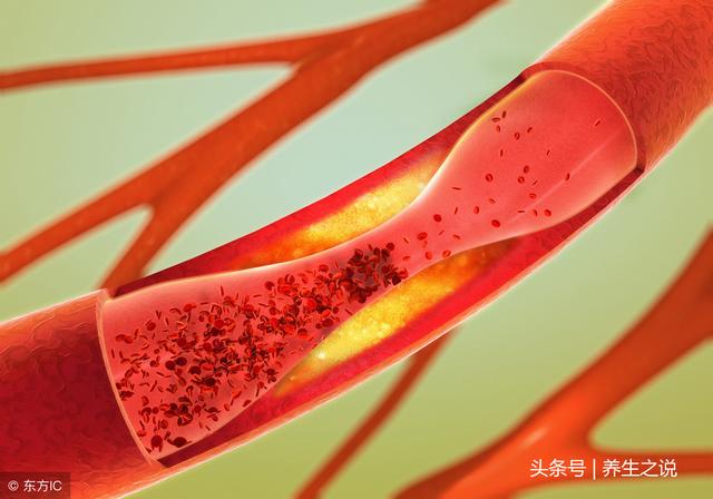 一旦腿部出现4种表现,可能是血管“堵”了,这3类人最好去查一下