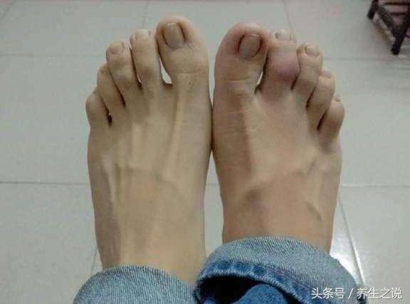 一旦腿部出现4种表现,可能是血管“堵”了,这3类人最好去查一下