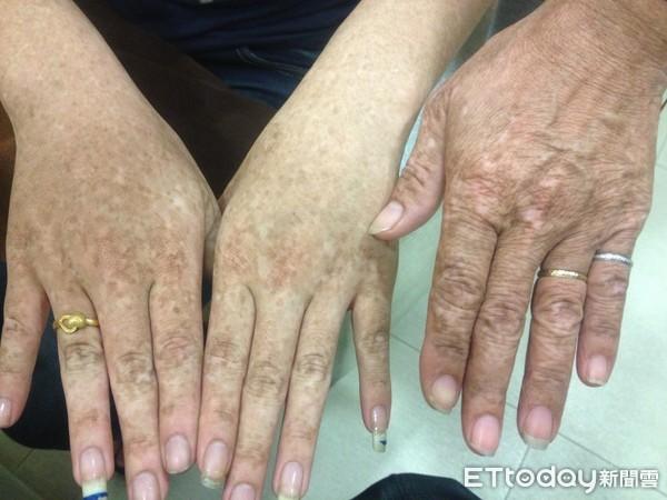 轻熟女皮肤爬满黑斑 竟是DNA缺陷