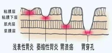 想要胃健康,保持4点好习惯,告别胃痛,预防胃炎