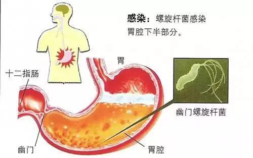 想要胃健康,保持4点好习惯,告别胃痛,预防胃炎