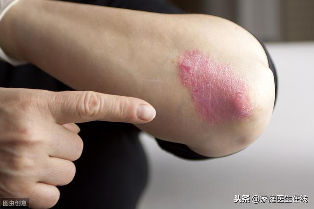 盘点:这几种让人痛苦的皮肤病,要做好预防措施