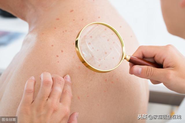 盘点:这几种让人痛苦的皮肤病,要做好预防措施