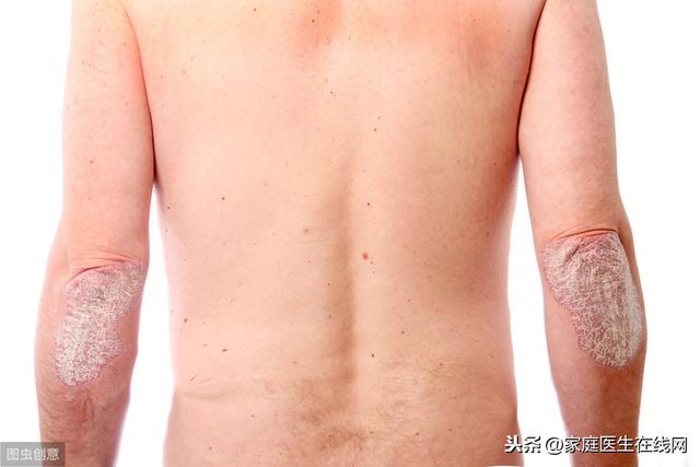 秋季如何预防皮肤病？做到这4点，疾病很难找到你