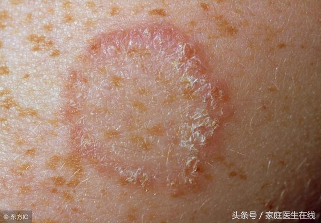 夏季害怕“惹上”手足癣，做好4件事，摆脱长癣噩梦