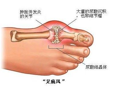 这几个预防痛风的小技巧，你需要知道