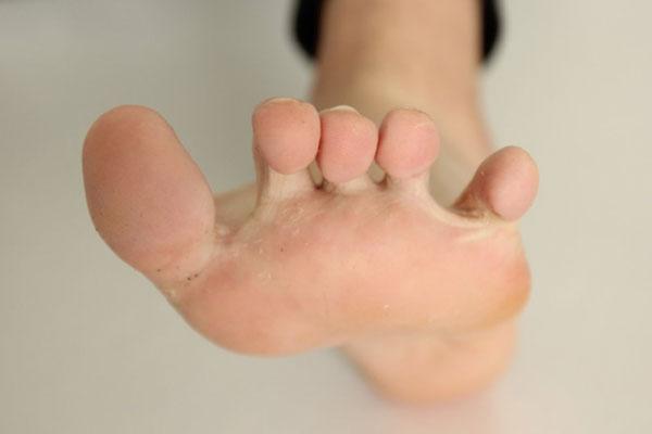 夏季足藓高发!哪些人更受脚气的“青睐”?如何预防脚气?