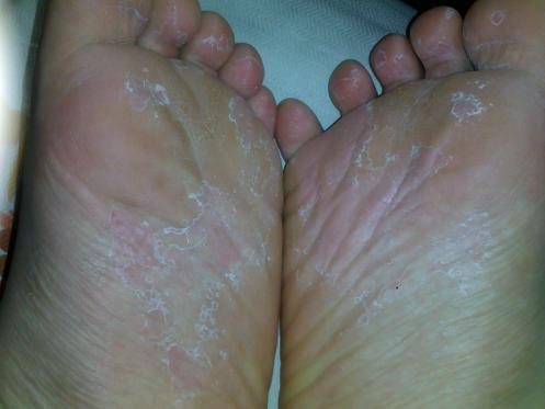 为何会得脚气?如何预防与治疗?