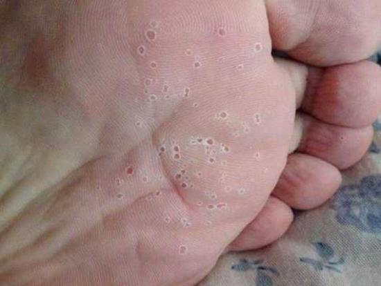 为何会得脚气?如何预防与治疗?