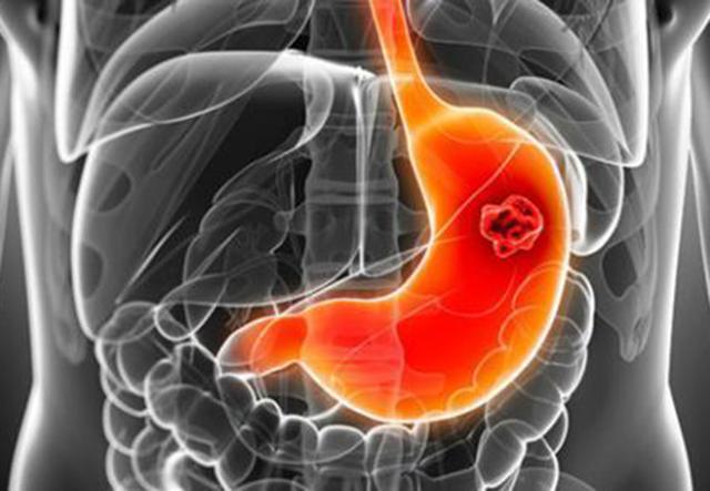 胃癌是胃病拖出来的，医生提醒：想让胃更好，牢记“3多3少”