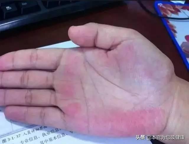 肝好不好,手先知?肝好的人,身上一般没有4异常,愿您全部没有
