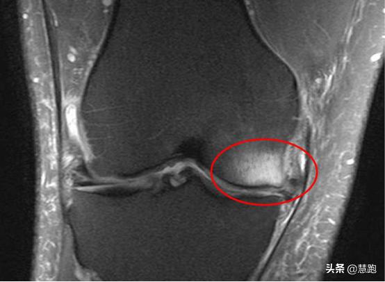 这些问题都搞不清难怪你膝痛！发现这种症状你必须休息3个月