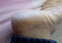 肾脏受到伤害，就会导致