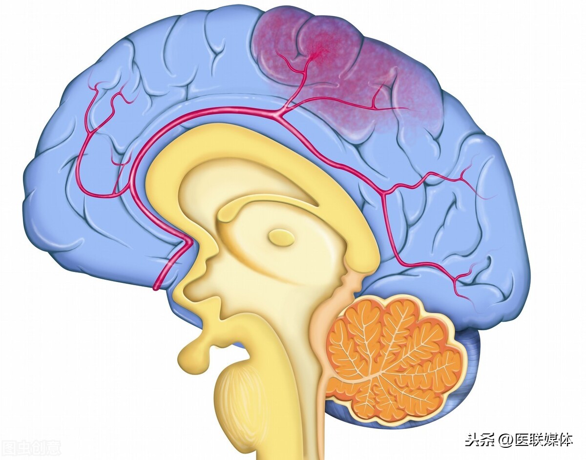 老年人如何预防脑出血?做好这3方面,别遭罪