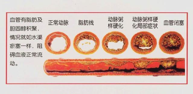 血管变硬，人短寿，每天“5坚持”，血管或许“返老还童”