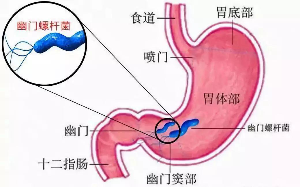 萎缩性胃炎和非萎缩性胃炎有什么区别？别治错了