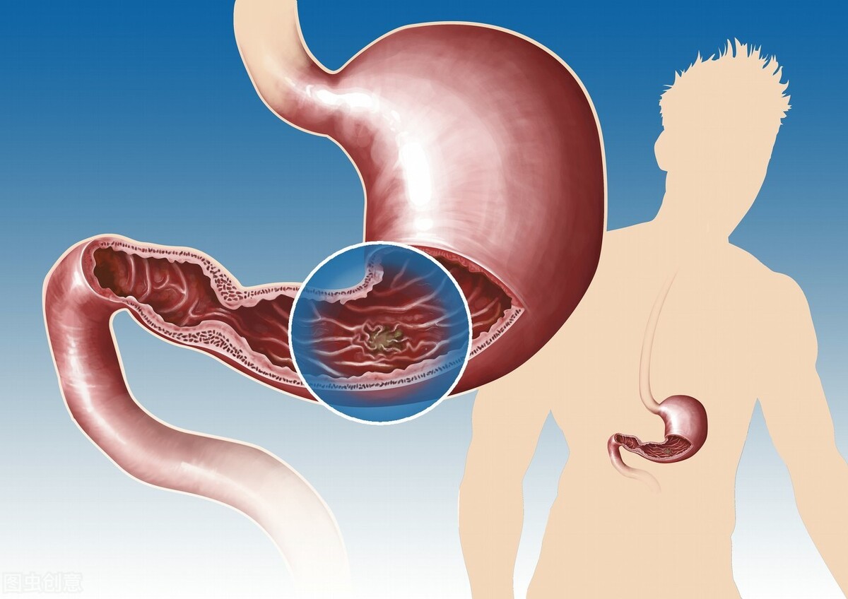 胃溃疡与药物有关？盘点胃溃疡的5大常见诱因，早了解早预防