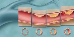 心绞痛，并最终导致心肌