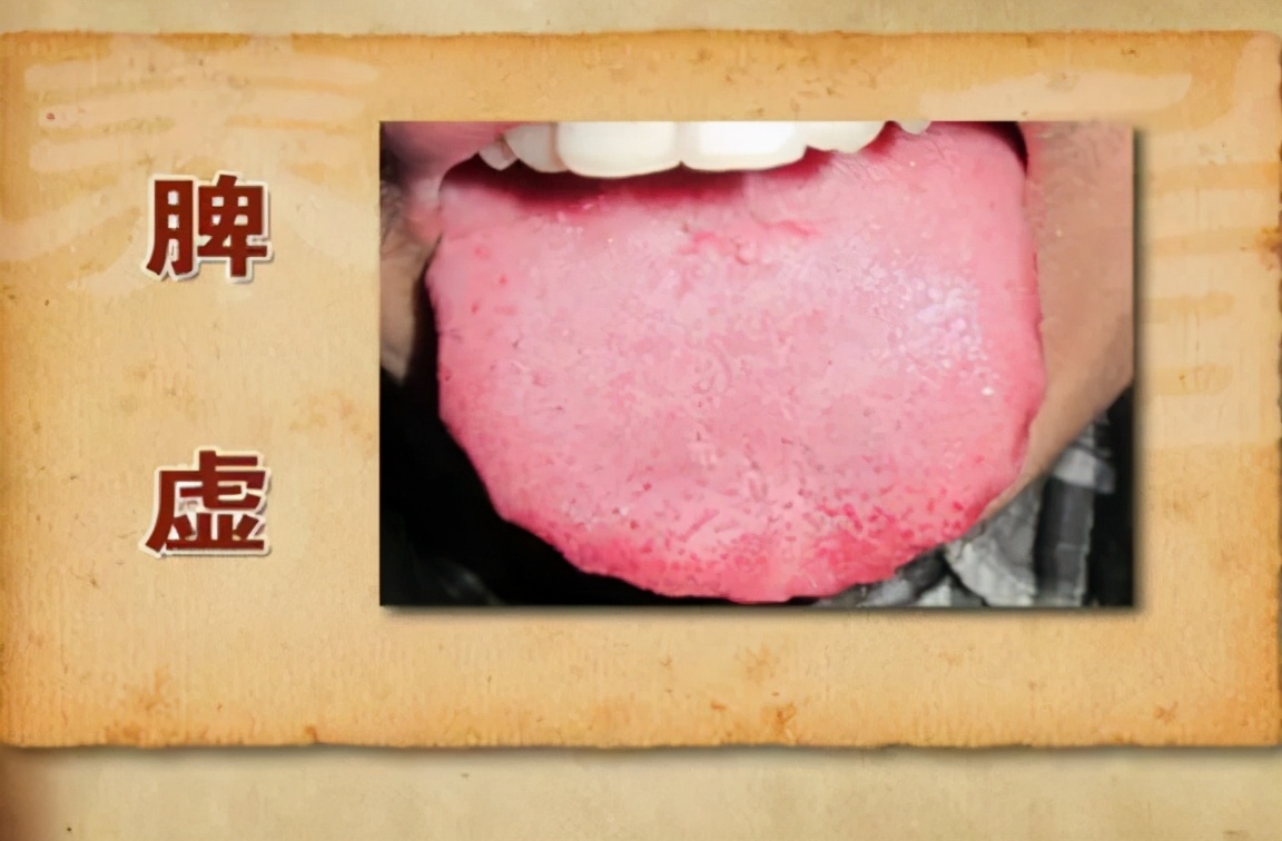 体内有脾虚,舌头先知道,舌头出现哪四种变化是脾虚呢