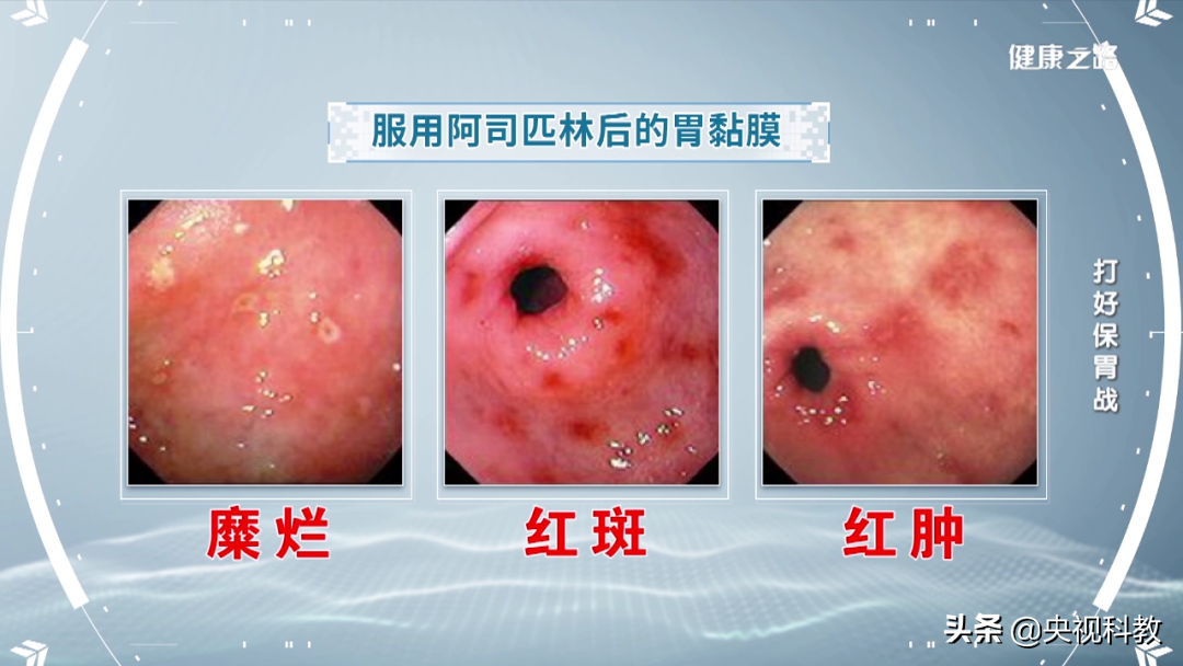 胃穿孔很可怕!日常生活要注意!