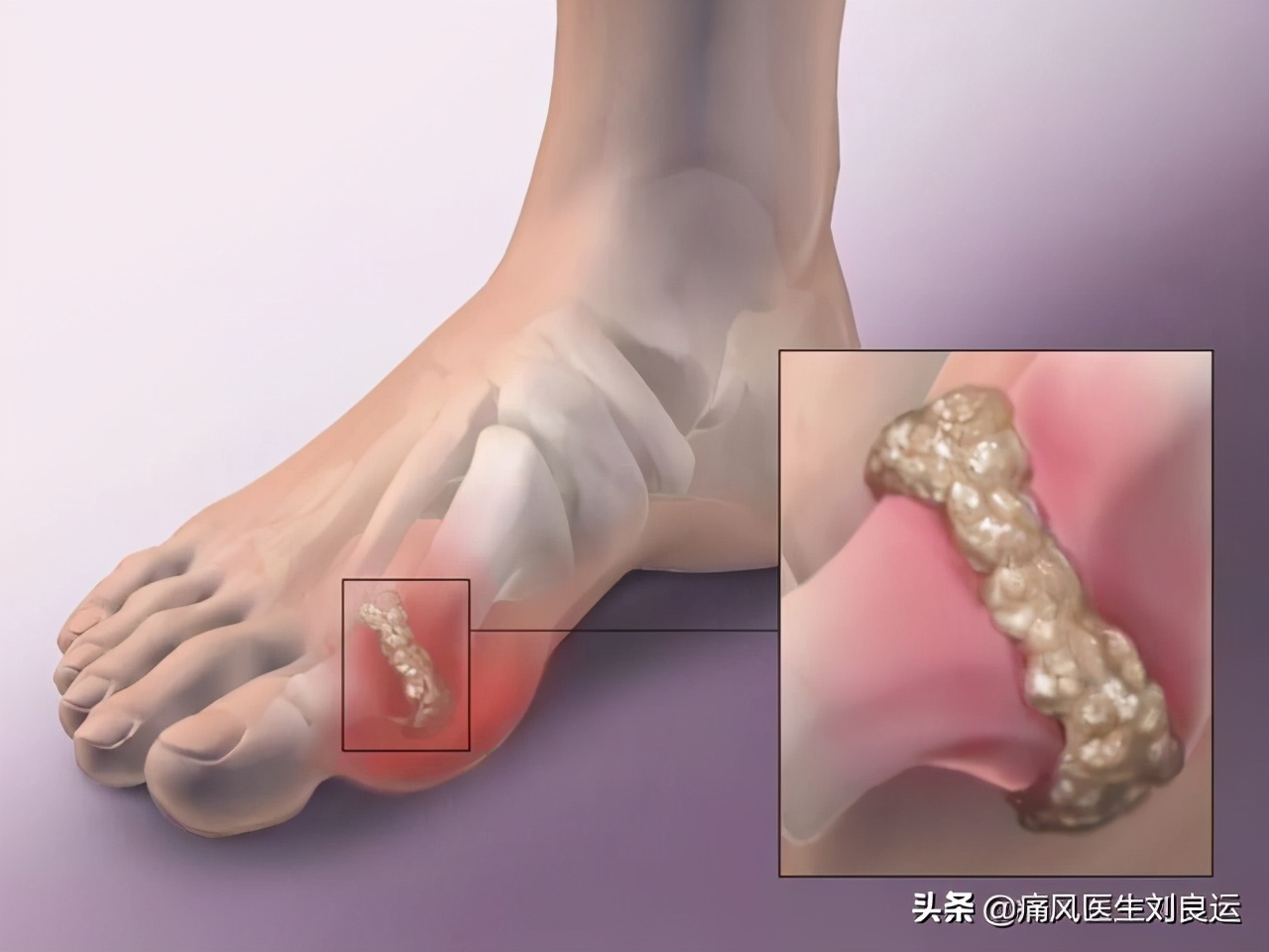 痛风不只是吃出来的病,医生教您避开尿酸高导致痛风的诱因