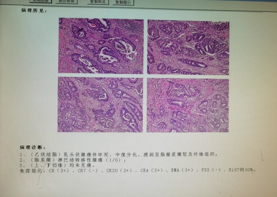 出现便血,是肠癌还是痔疮?医生教你从三方面辨别,别再混淆了