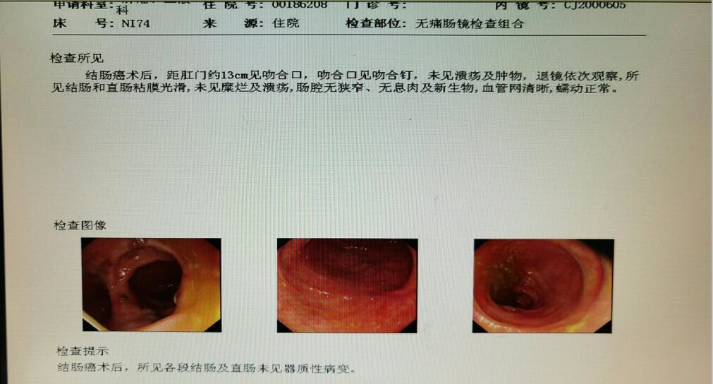 出现便血,是肠癌还是痔疮?医生教你从三方面辨别,别再混淆了
