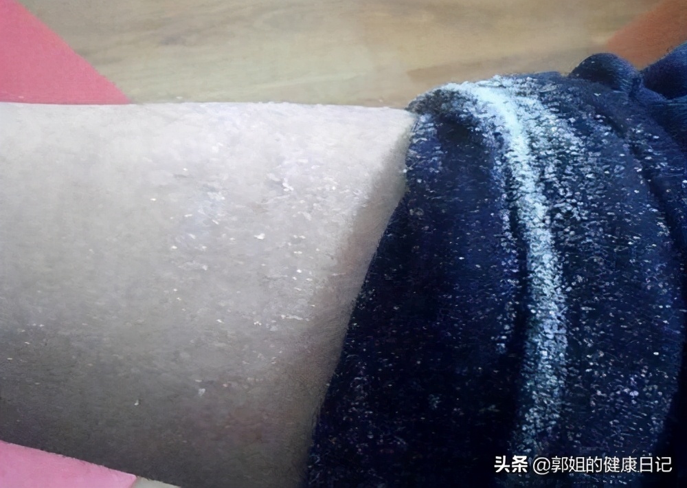 皮肤出现脱皮屑现象,是身体缺乏1种维生素了,赶紧补充