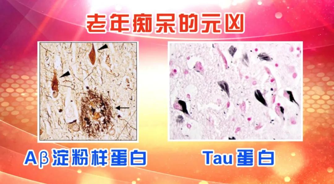 睡眠差易引发老年痴呆!一顶“聪明帽”,改善睡眠,老来预防痴呆