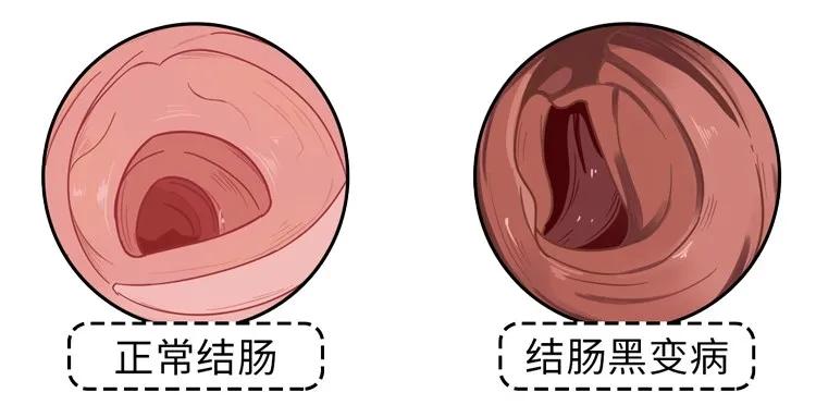 排宿便、清肠毒就能美容减肥?不要再信广告了,坑钱还伤身体