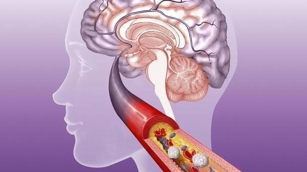 3种食物经常吃,可能会使血管变脆变硬,请你“嘴下留情”