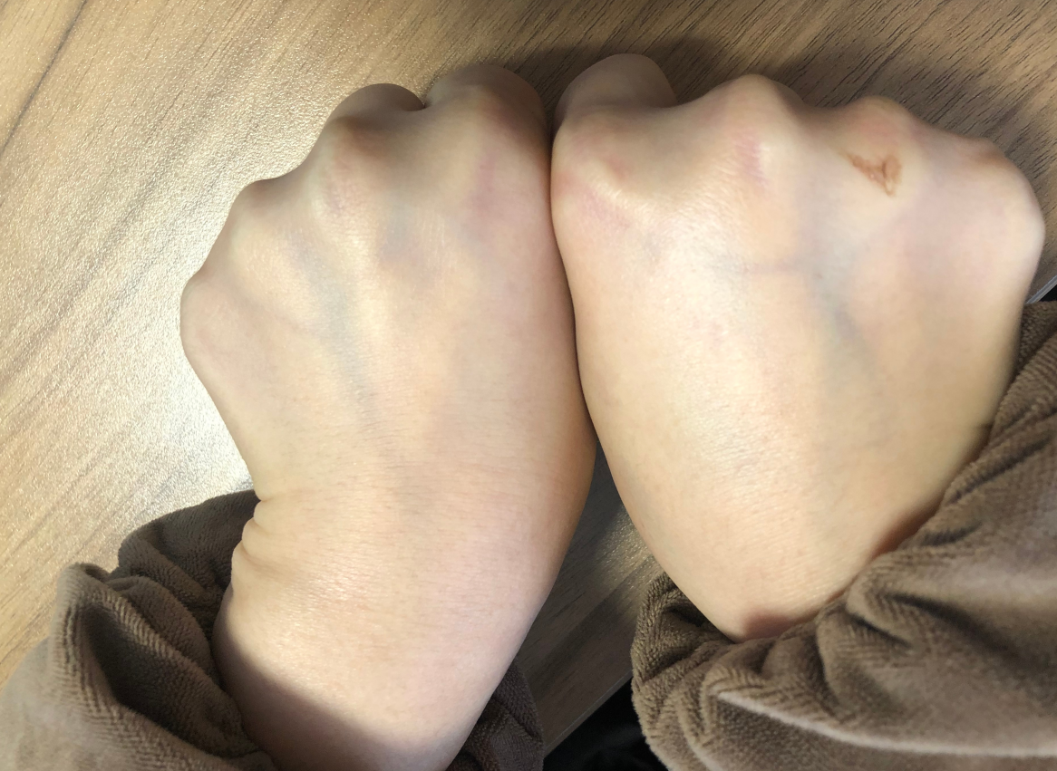 手上的青筋越多,说明哪些健康问题?3个健康小常识,需要弄清楚