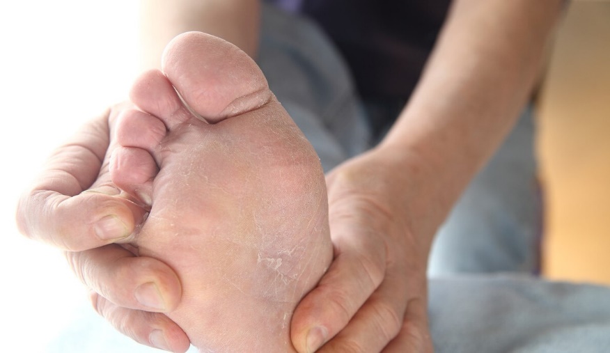 肝不好，没有明显症状？看看你的脚，有4种异常就是"危险信号"