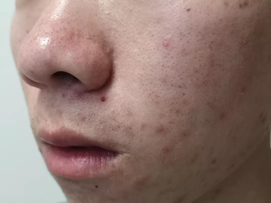 不同部位痘痘和内脏有关?