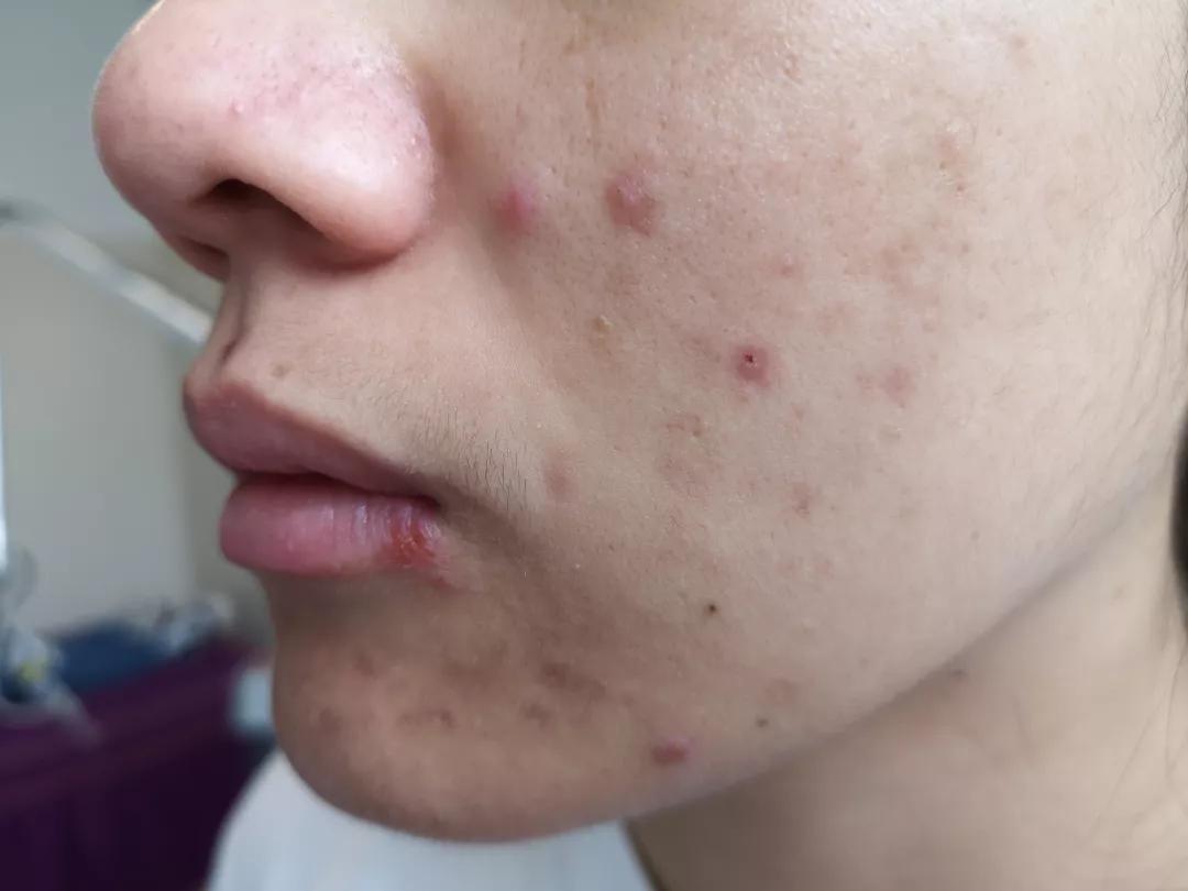不同部位痘痘和内脏有关?