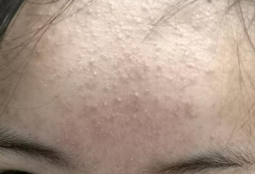 不同部位痘痘和内脏有关?