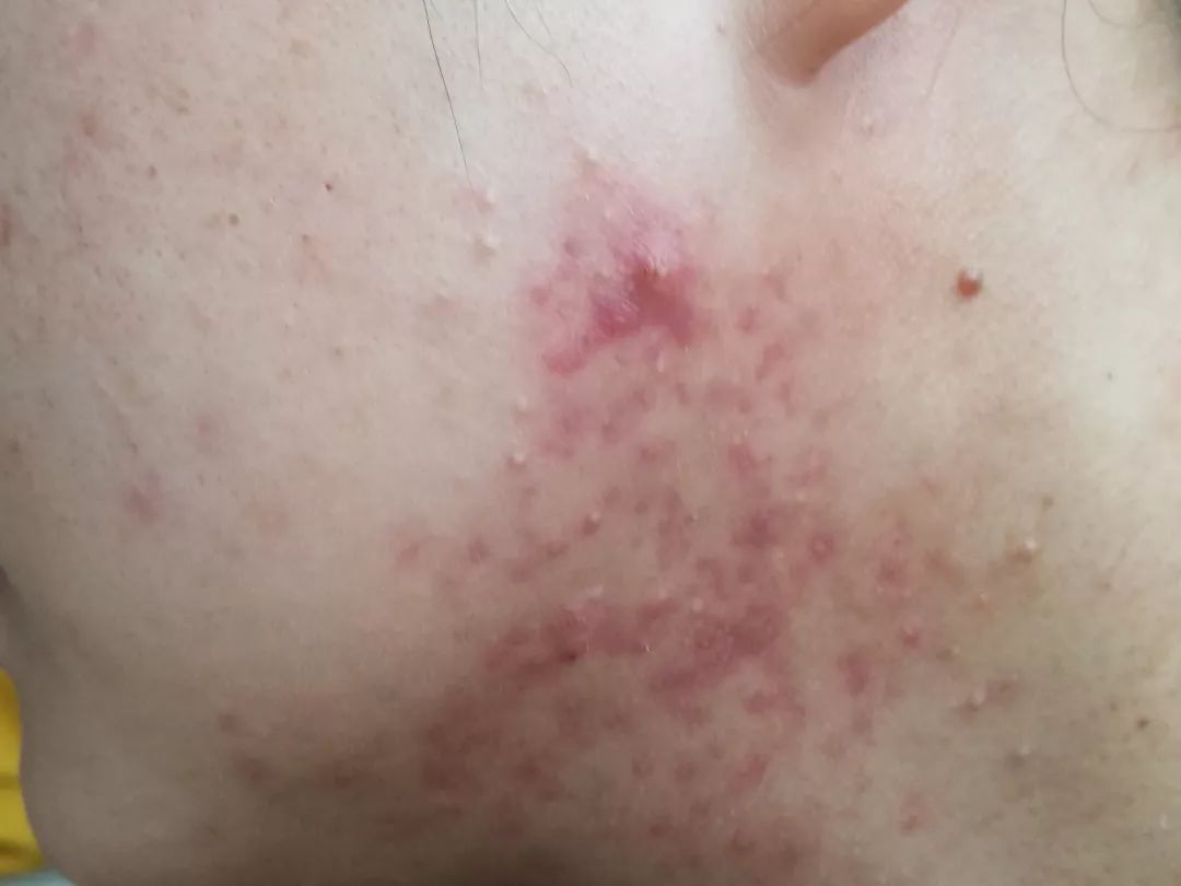 不同部位痘痘和内脏有关?