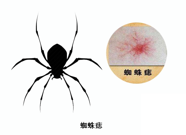 皮肤上出现这种“小红点”,或是肝脏出了问题,4类人别视若无睹