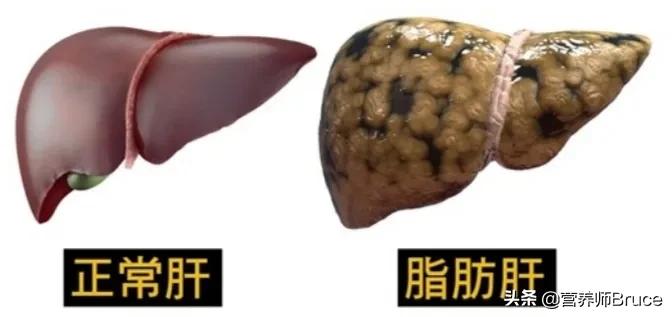 吃枸杞,能不能逆转脂肪肝?