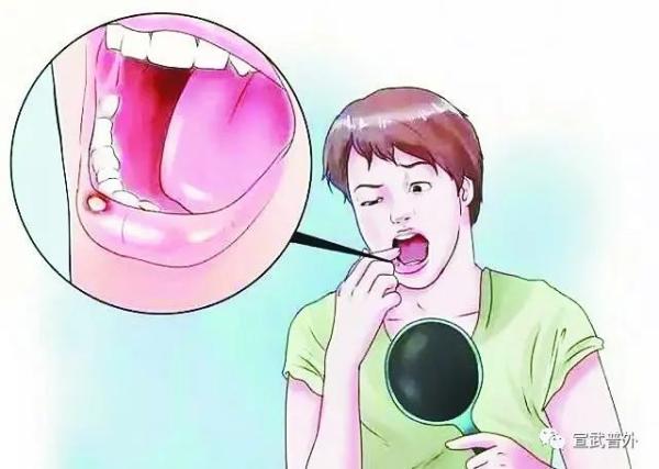 口腔溃疡怎么办呀？