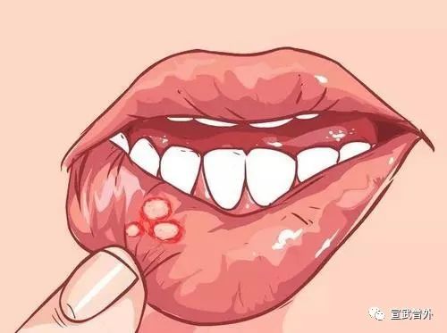 口腔溃疡怎么办呀？
