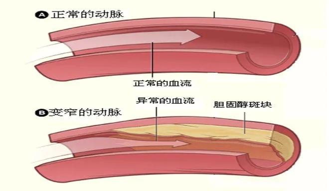 动脉斑块可以通过吃药治愈吗?3个前提条件缺一不可!医生讲清楚