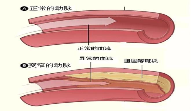 动脉斑块可以通过吃药治愈吗？3个前提条件缺一不可！医生讲清楚