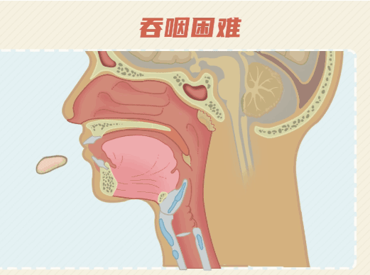 吃饭容易呛?喝水总是咳?警惕这种“隐形杀手”