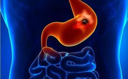 胃炎患者生活应该保持规律，少吃刺激性食物